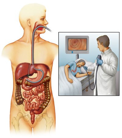 after effects of endoscopy